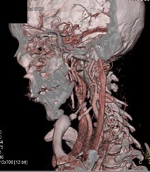 Carotid Artery Ectasia - CTisus CT Scan