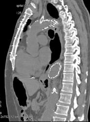 Endovascular Stent F/u With Leak - CTisus CT Scan