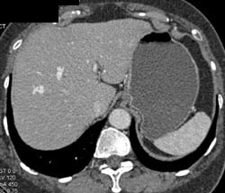 Av Shunt in Liver - CTisus CT Scan