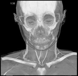 Loeys-Dietz Without Dissection - CTisus CT Scan