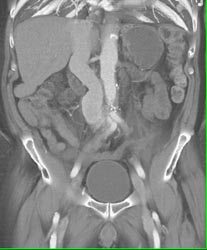 Early IVC Filling ?? Fistulae and Ivc - CTisus CT Scan