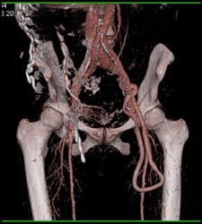 Av Shunt in Left ?? - CTisus CT Scan