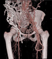 Collaterals RLQ and Dilated Gonadal Vein - CTisus CT Scan