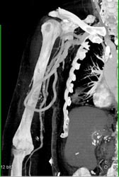 Av Dialysis Graft - CTisus CT Scan