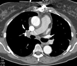 Focal Aortic Ulceration - CTisus CT Scan