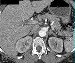 Focal Dissection Near Celiac Artery - CTisus CT Scan