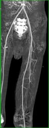 Collateral in Left SFA - CTisus CT Scan