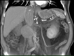 Left Gonadal Vein - CTisus CT Scan