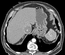 IVC Sarcoma Extends Into Intrahepatic IVC - CTisus CT Scan