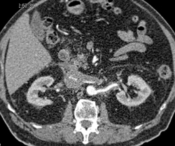 Tumor Extends From IVC to Left Renal Vein - CTisus CT Scan