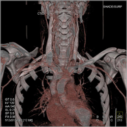 Trauma to Left Common Carotid Artery - CTisus CT Scan