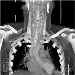 Jugular Vein - CTisus CT Scan