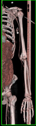 CTA Arm Is Normal - CTisus CT Scan