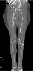 Occluded Left and Right SFAs - CTisus CT Scan