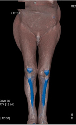 Steps for Bone Removal Seen in Case 14 - CTisus CT Scan