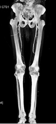 Patent Proximal SFAs - CTisus CT Scan