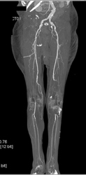 Occlusion Common Femoral Artery - CTisus CT Scan