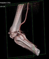 Nail Gun Shot in Knee With Vascular Injury - CTisus CT Scan