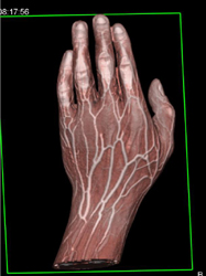 CTA of Wrist - CTisus CT Scan