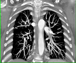 Pulmonary Embolism - CTisus CT Scan