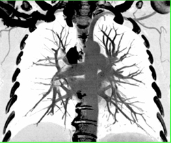 Pulmonary Embolism - CTisus CT Scan