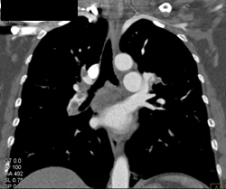 Pulmonary Embolism - CTisus CT Scan