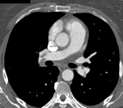 Pulmonary Embolism - CTisus CT Scan