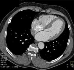 Big Left Ventricle - CTisus CT Scan