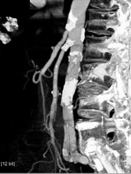 Diseased But Patent SFA-also Review Neuro MRI - CTisus CT Scan