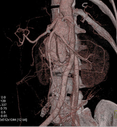 SMA Aneurysm-venous Maps May But Are Small - CTisus CT Scan