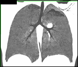 Patent Airway - CTisus CT Scan