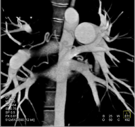 Bronchial Artery - CTisus CT Scan