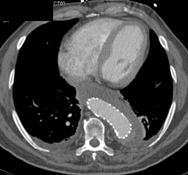 Leak From Endovascular Stent - CTisus CT Scan