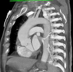 Mildly Dilated Root - CTisus CT Scan