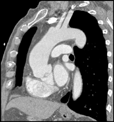 Coarctation of the Aorta - CTisus CT Scan