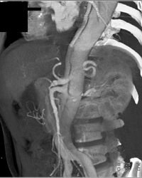 Type B Dissection - CTisus CT Scan