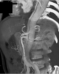 Type B Dissection - CTisus CT Scan