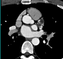 High Origin of the RCA - CTisus CT Scan