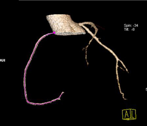 Normal RCA - CTisus CT Scan