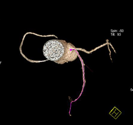 Normal RCA - CTisus CT Scan