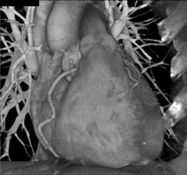 Normal RCA - CTisus CT Scan