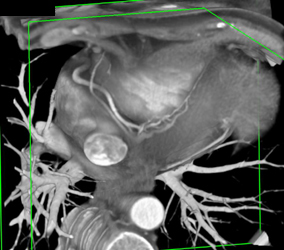 Normal RCA - CTisus CT Scan