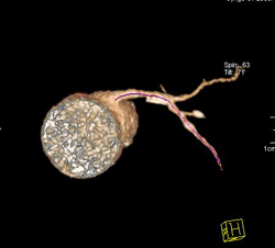 Plaque in LAD - CTisus CT Scan