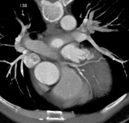 Plaque in LAD - CTisus CT Scan