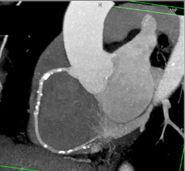 Plaque in RCA - CTisus CT Scan