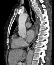 Dissection Repair - CTisus CT Scan