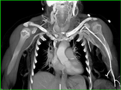 Axillary Arteries - CTisus CT Scan