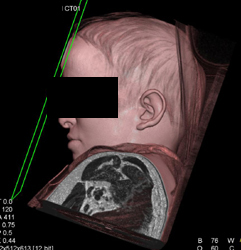 ??? Something Hair - CTisus CT Scan