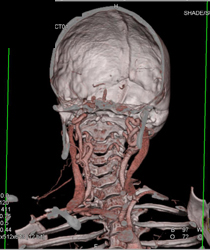 Loeys-Dietz With Ectatic Vessels - CTisus CT Scan