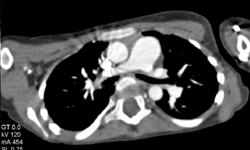 Prominent Pulmonary Arteries - CTisus CT Scan